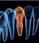 הבשורה של השתלות שיניים מתקדמות-תמונה